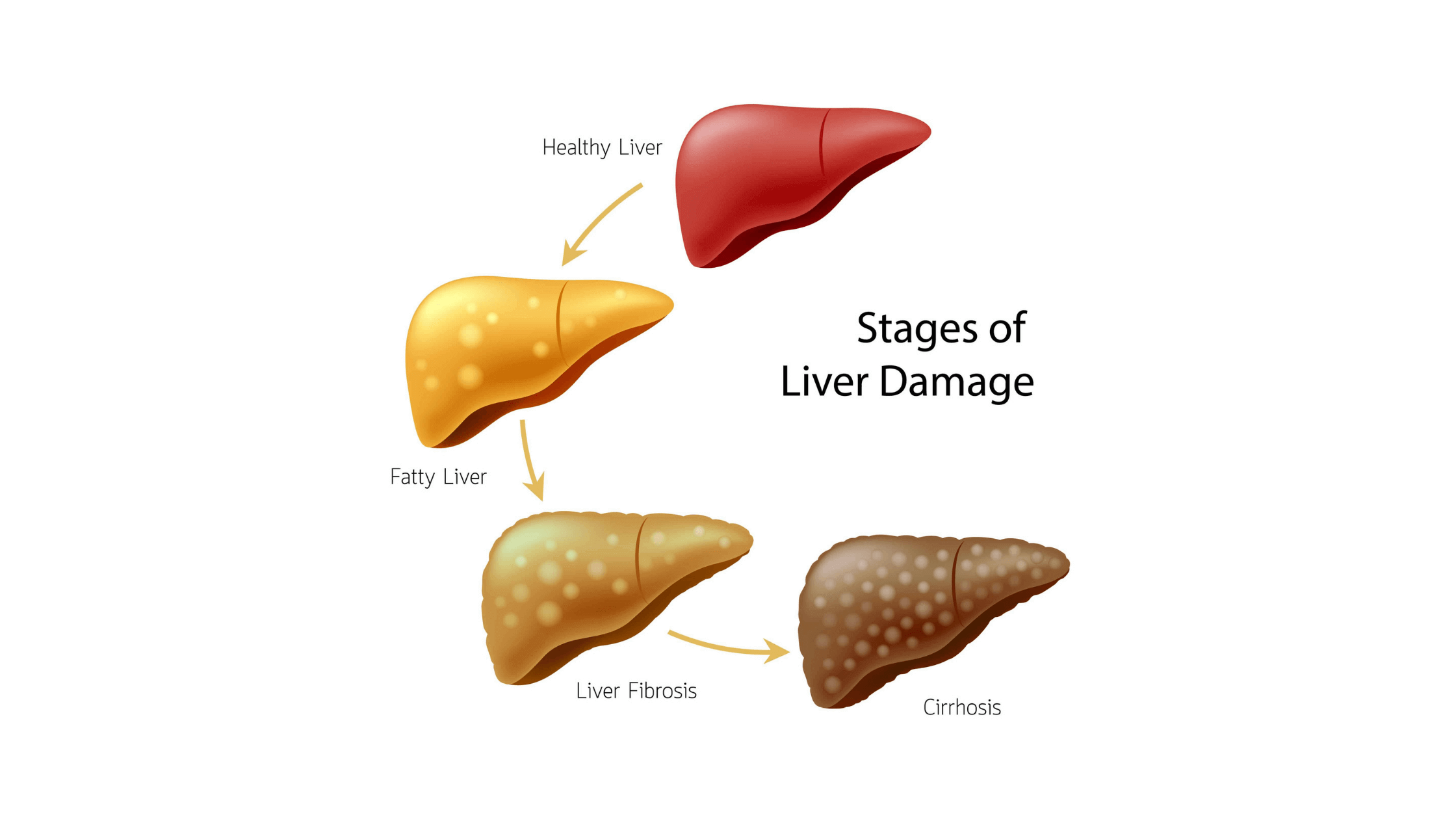 The Non Alcoholic Fatty Liver Disease Solution - Stages of damage