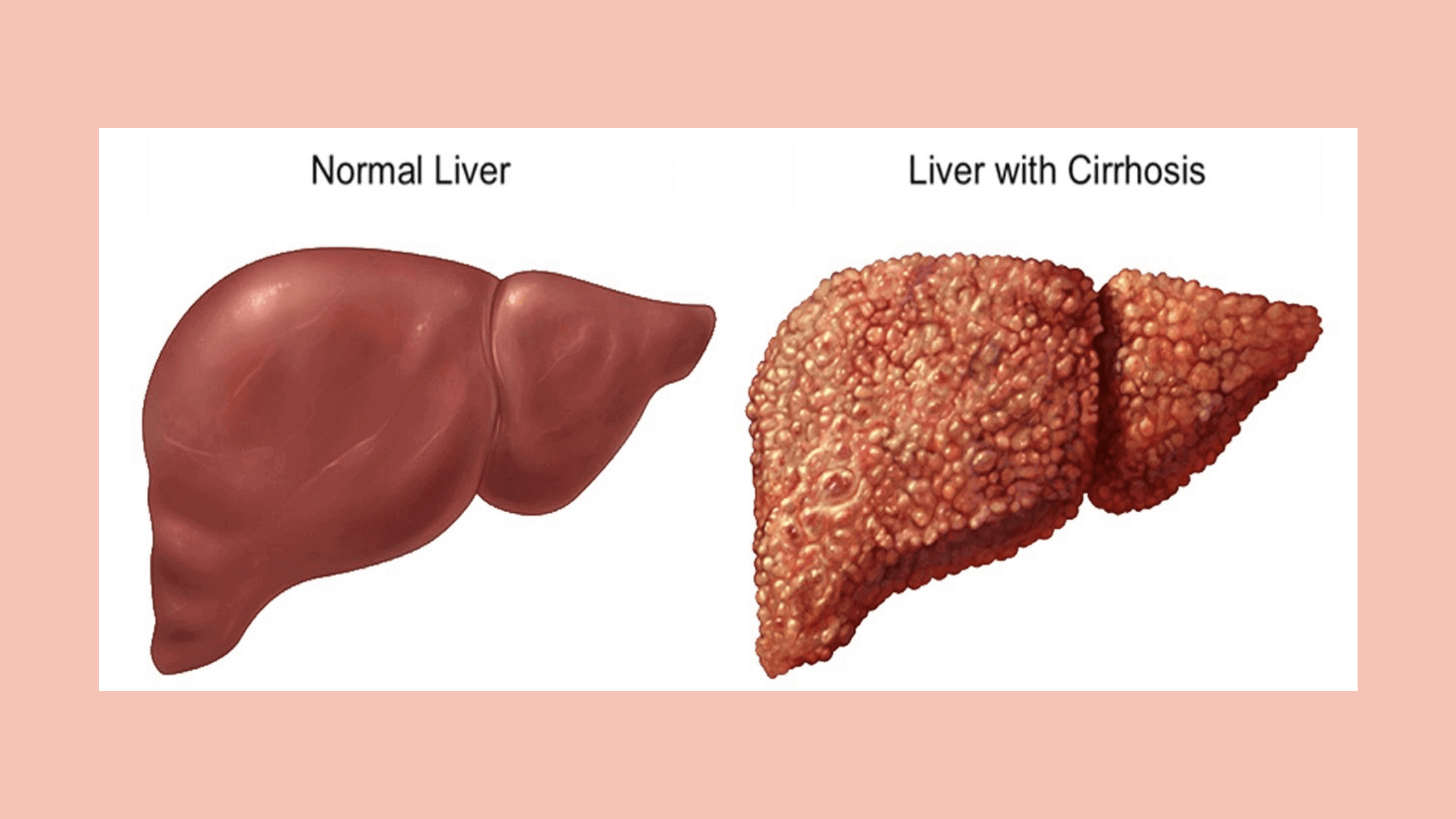 The Non Alcoholic Fatty Liver Disease Solution - Normal Liver and damaged Liver